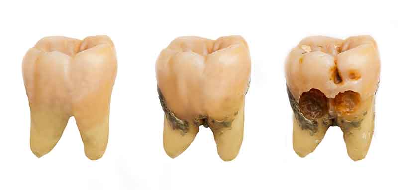 caries causas y tratamiento