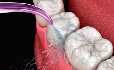 qué es el irrigador dental y cómo usarlo 