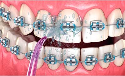 qué es el irrigador dental y cómo usarlo 