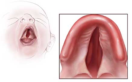 ¿Qué son el labio leporino y el paladar hendido? 