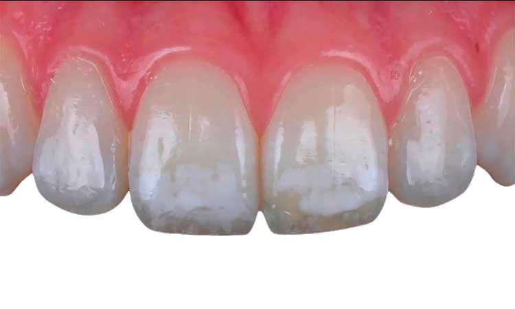 causas y tratamiento de la fluorosis