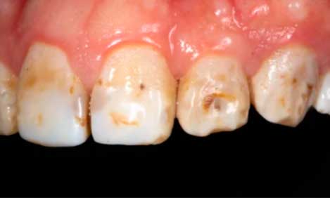 causas y tratamiento de la fluorosis